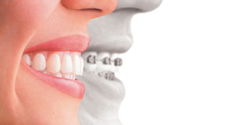 BENEFITS OF ADOPTING ALIGNERS IN YOUR ORTHODONTIC CLINIC