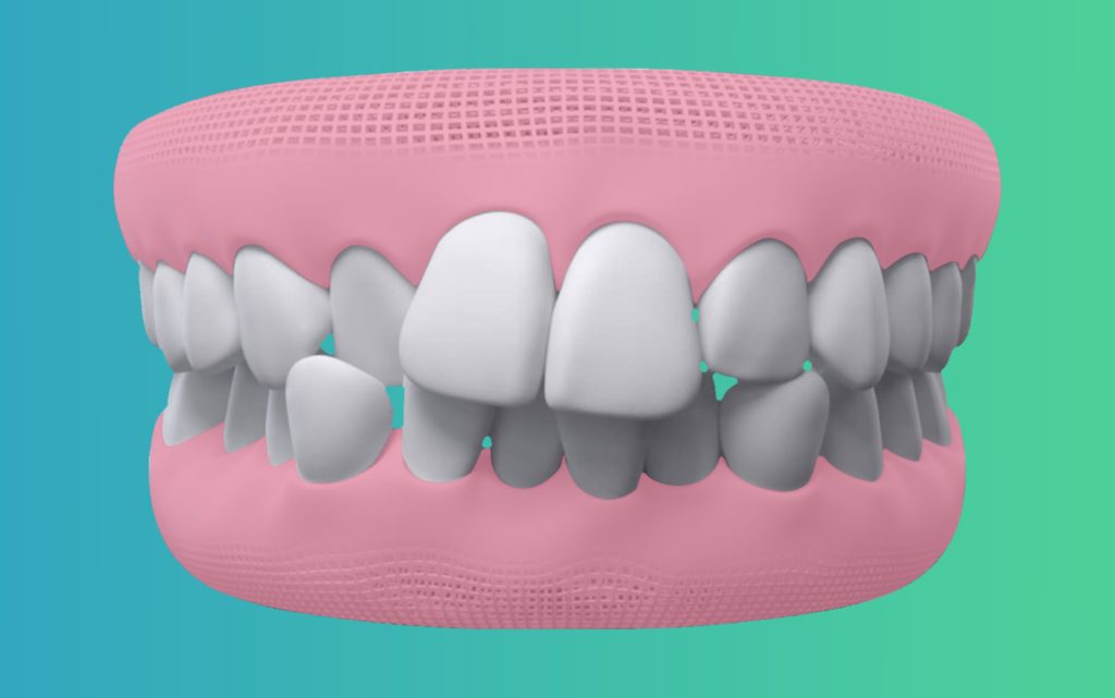 Crowded Teeth treatment in india by eledent aligners