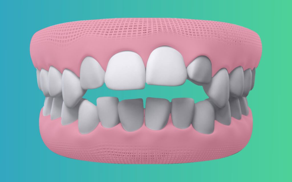 openbite Teeth treatment in india by eledent aligners
