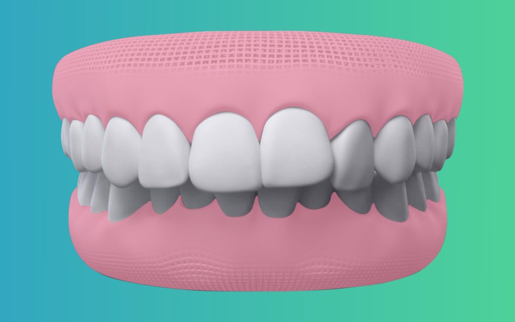 overbite Teeth treatment in india by eledent aligners