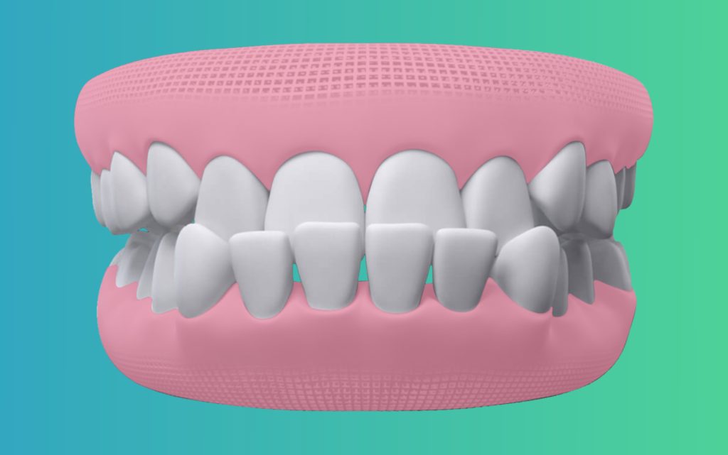 underbite Teeth treatment in india by eledent aligners