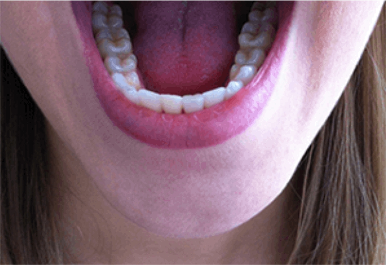 eledent aligner after- eledentaligners.in