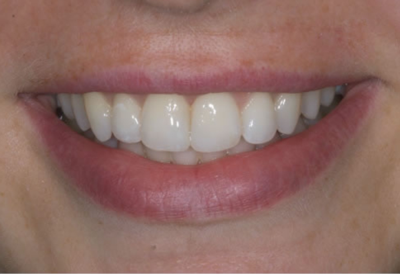 eledent aligner after - eledentaligners.in