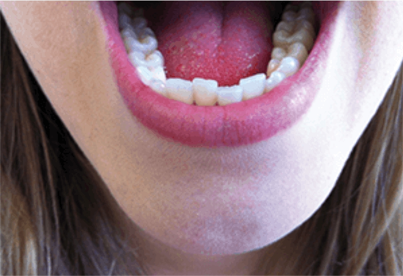 eledent aligner before - eledentaligners.in