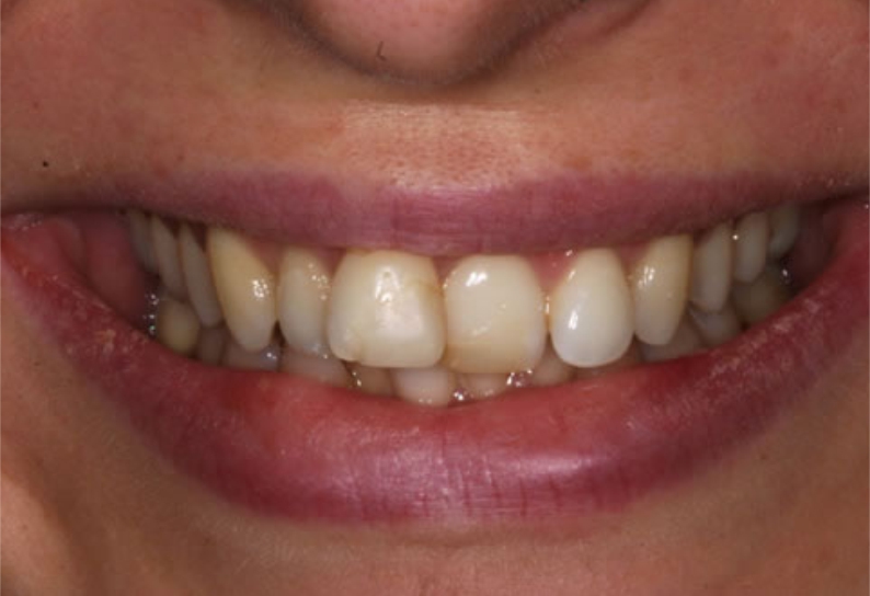 eledent aligner before - eledentaligners.in