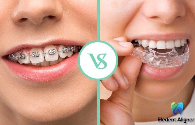 What is Invisible or Clear Aligner? Which is better Eledent Aligners or Braces