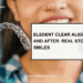 clear aligners before and after