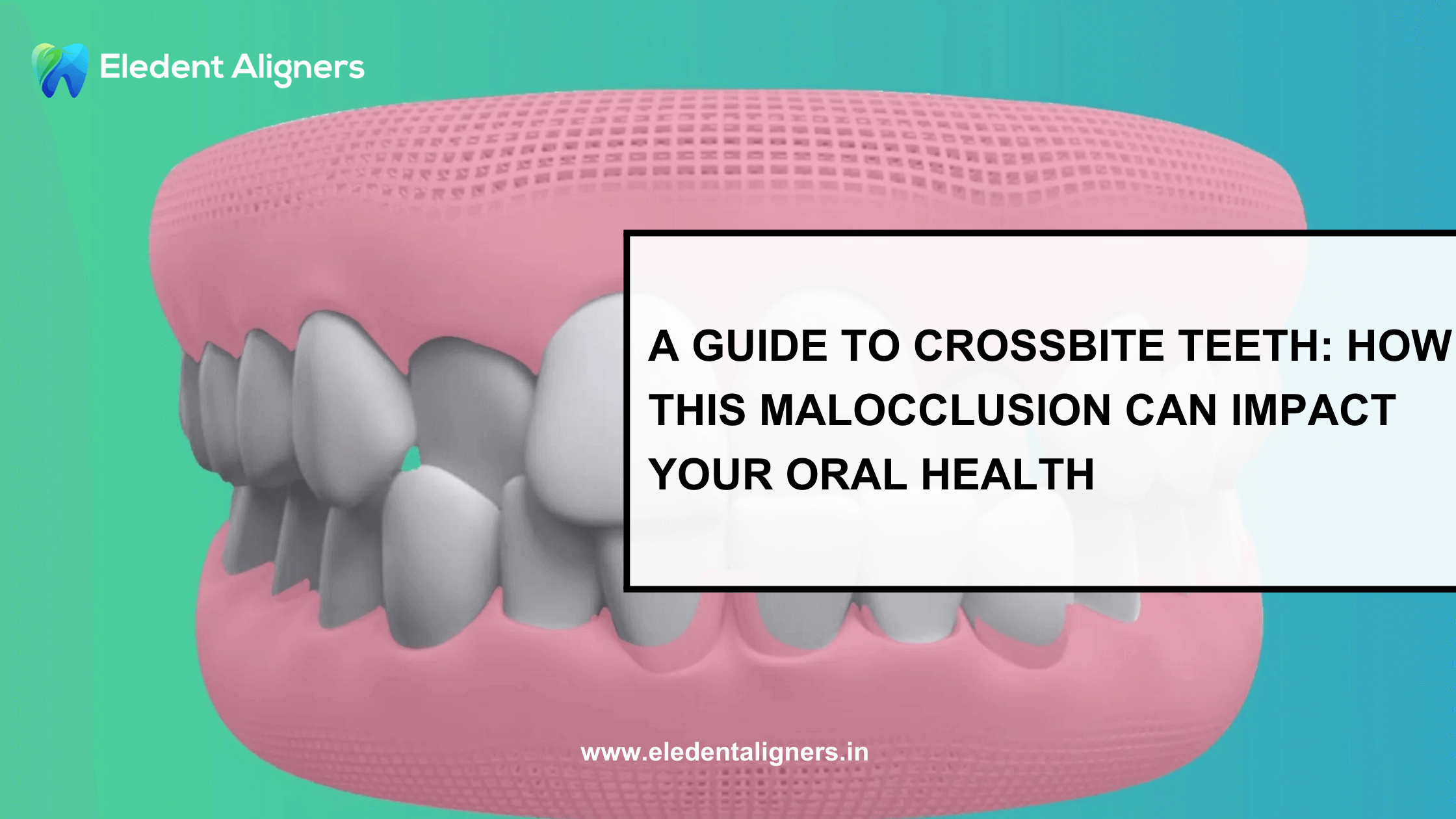 A Guide to Crossbite Teeth: How This Malocclusion Can Impact Your Oral Health