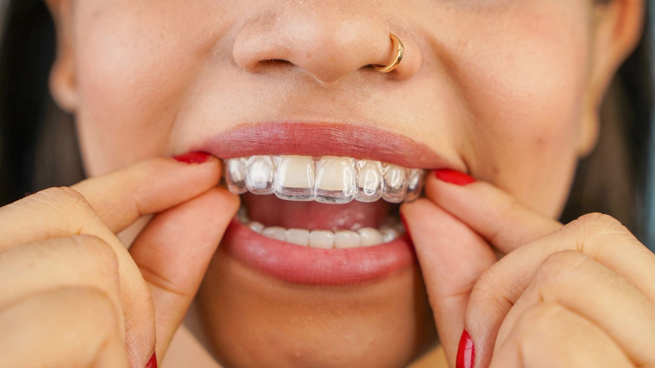 clear aligners treatment time