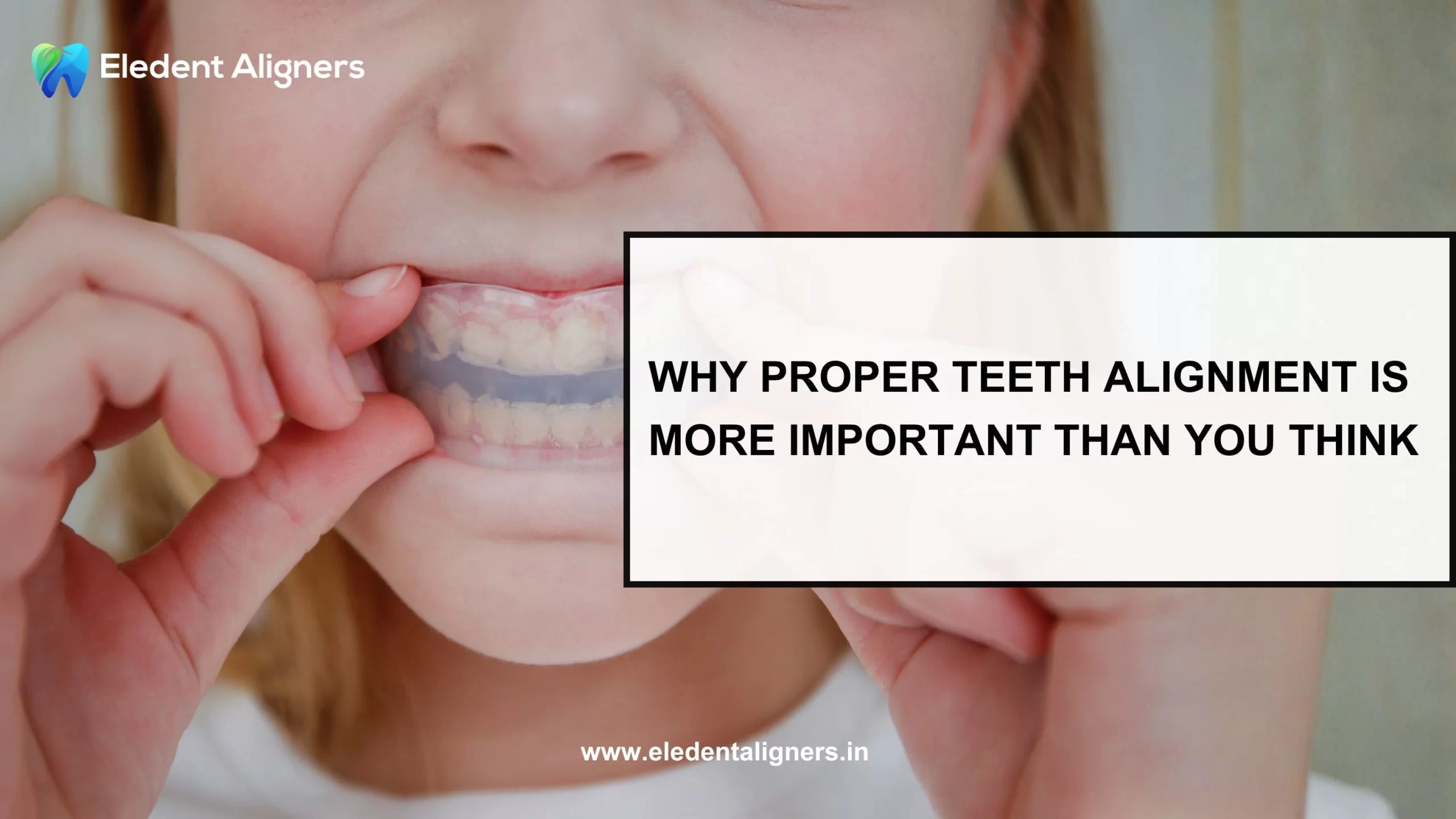 Why Proper Teeth Alignment is More Important than You Think